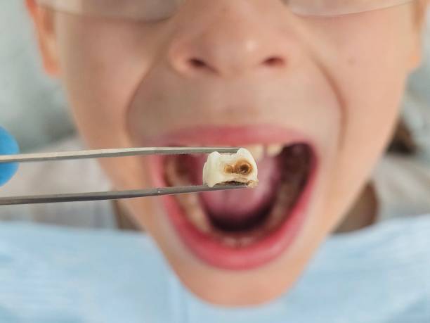 Best Emergency Treatment for Dental Infections or Abscesses in Lakeland, MN
